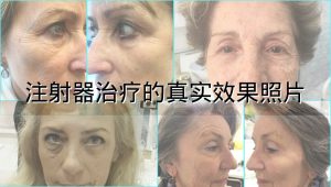 注射器治疗的真实效果照片